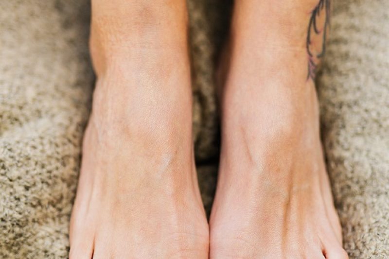 Yellow Toenails- Not a Site for Sore Eyes!