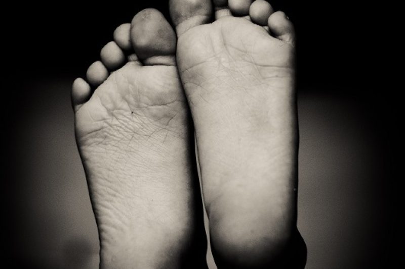 Flat Feet (Flatfoot) - Symptoms and Treatments