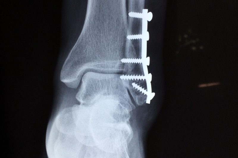 What are stress fractures
