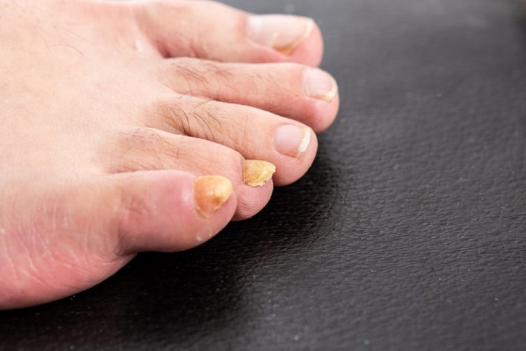Why are My Toenails Yellow? Put Your Feet First
